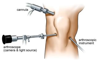 Arthritis Keyhole Surgery Cost