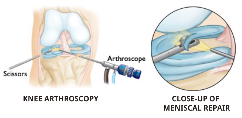 arthroscopic keyhole surgery