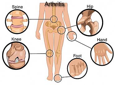 Best Arthritis 