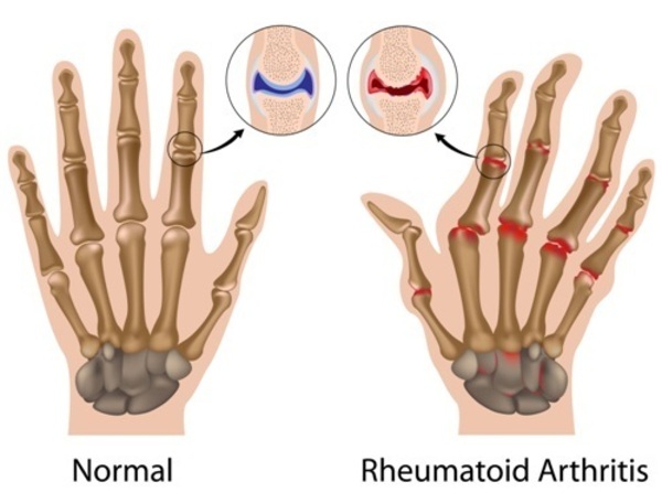 Best arthritis doctor